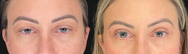 blef-img