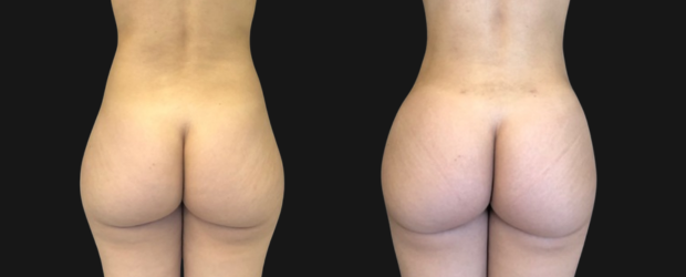gluteo-img-02