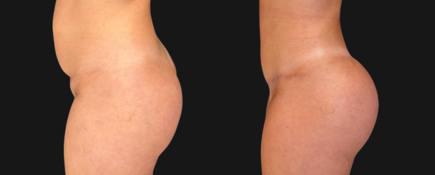 gluteo03-3